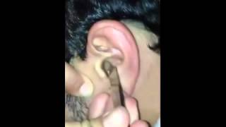 Popping a gross pimple in the ear Acne treatment 2015