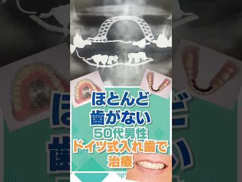 ほとんど歯がなく、全て抜かなければいけないと言われた50代男性患者様