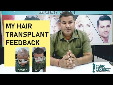 कैसे हेयर ट्रांसप्लांट से इनका आत्मविश्वास वापिस आया|  #hairtransplant #clinicgennext