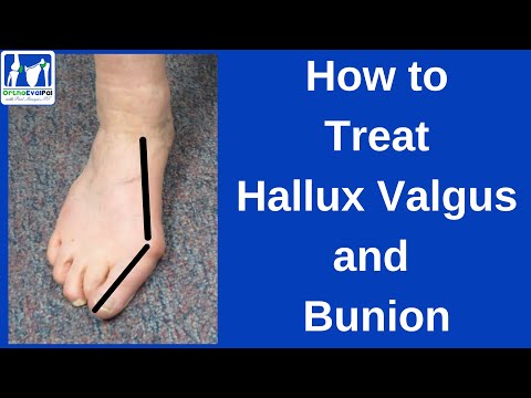 Metatarsalgia and Morton s Neuroma Evaluation and Treatment