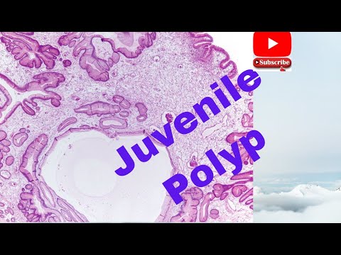 Juvenile Polyp-  Are you aware of high yield facts?. Watch now- usmle, neet pg, plab, fmge