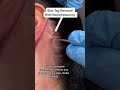 Entfernung Von Hautanhängseln Mit Radiofrequenz Schnelle Und Sichere Behandlung DRMEDISPA