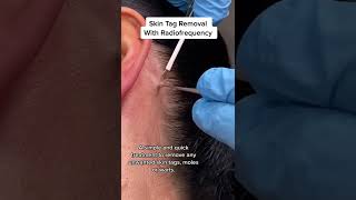 Skin Tag Removal With Radiofrequency | Quick & Safe Treatment DRMEDISPA