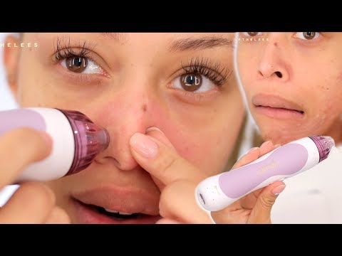 At-Home MicroDermabrasion: Does it work?!   | LEESA