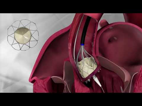 Portico Transcatheter Aortic Heart Valve