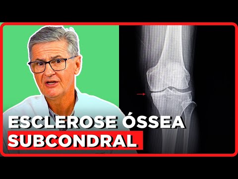 O que é Esclerose Óssea Subcondral? | Simplificando Ortopedia com Dr. Robert Wagner