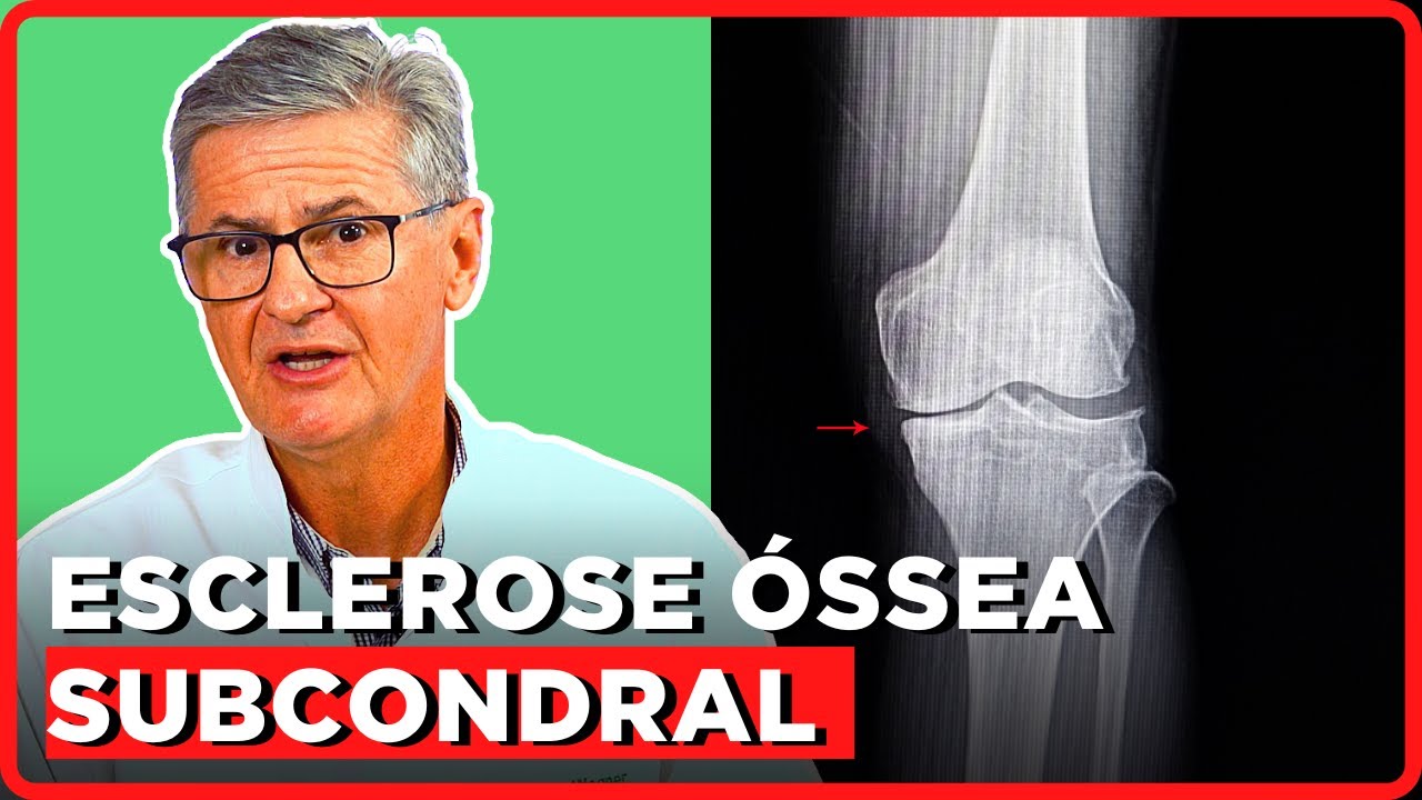 O que é Esclerose Óssea Subcondral? | Simplificando Ortopedia com Dr. Robert Wagner