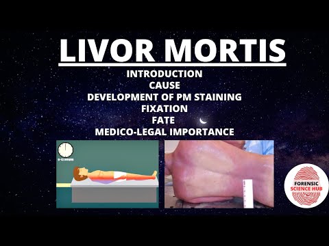 Bruising | Cause | Development | Fixation | Fate | Medicolegal importance | Forensic medicine