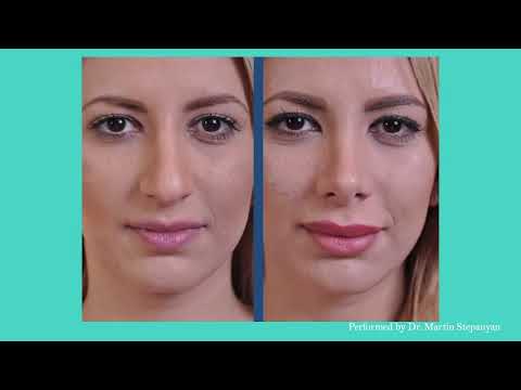 Beverly Hills' Top Plastic Surgeon: Dr. Martin Stepanyan's Stunning Before & After Magic!