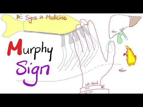 Murphy Sign for Cholecystitis | Signs in Medicine Series