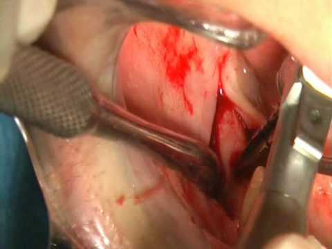 Perché può far male al collo sotto il mento Mal di gomiti pomata