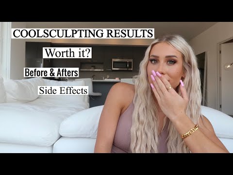 Does Coolsculpting Work? Results + Review