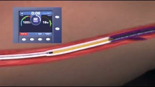 Eliminación de varices por RadioFrecuencia