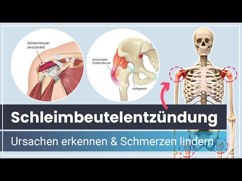 Schleimbeutelentzündung ➡️ Ursachen der Bursitis erkennen & Schmerzen lindern
