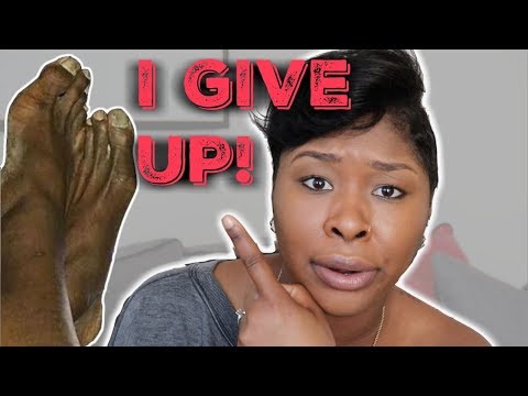 Cosmetic Toe Shortening Long Toe Surgery Video Without Metal Pins