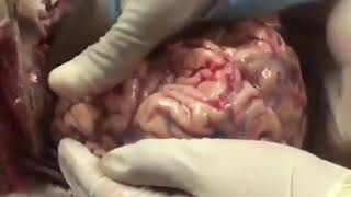 Removing the human brain during autopsy