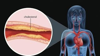 Heart Disease and Menopausal Women