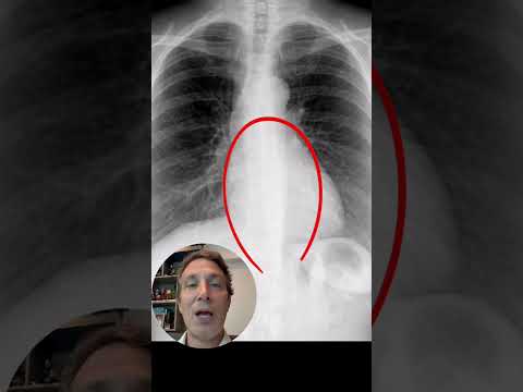 Let's "learn" how to read a chest X-ray!
