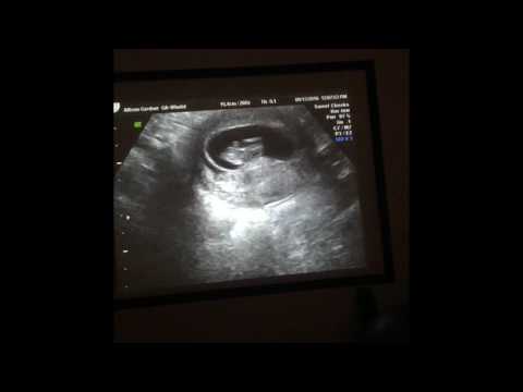 Heartbeat Ultrasound - We cheated! (Sweet Cheeks - Lancaster, CA)