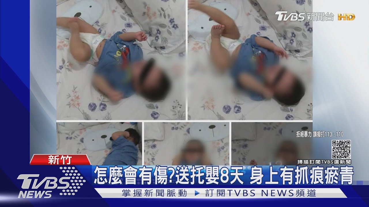 怎麼會有傷?送托嬰8天 身上有抓痕瘀青