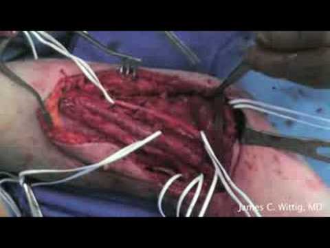 Całkowita proteza łopatki z powodu mięsaka Ewinga - część 2