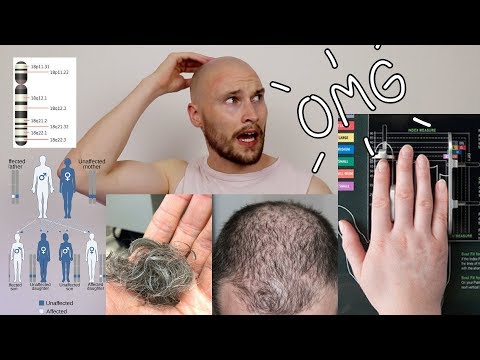 What are the early signs of male pattern baldness?