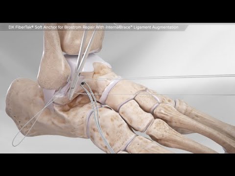 DX FiberTak® Soft Anchor for Brostrom Repair With InternalBrace™ Ligament Augmentation