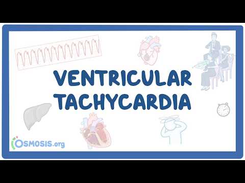 Ventricular tachycardia