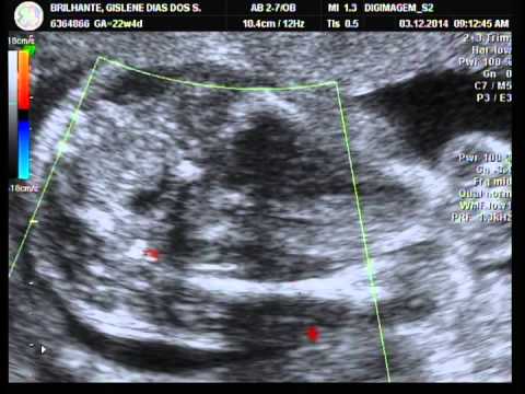 Ultrassom Amanda! 03-12-2014 - Seja bem vinda minha filha!