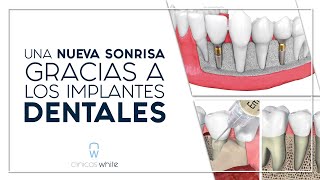 Una Nueva Sonrisa Gracias a los Implantes Dentales - Clínicas White