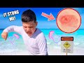 HE got Stung at the BEACH by JELLYFISH!!