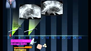 Preparación endometral para transferencia de embriones criopreservados