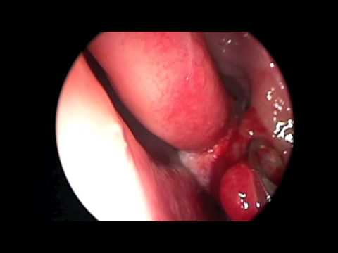 Removal of Sinus Granulation