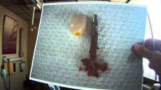 Implant Infection Removal #6