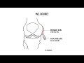 MCL Knee Tear Explained Symptoms, Grades and Treatment