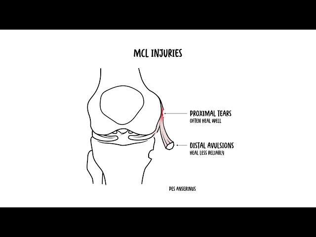 MCL Knee Tear Explained Symptoms, Grades and Treatment
