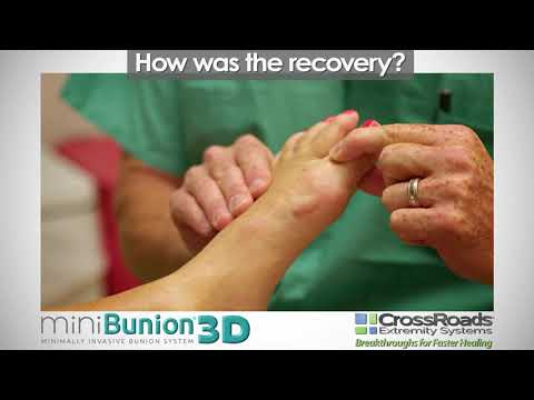 miniBunion® 3D FAQs "How was the recovery?"