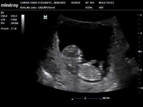 Como se ve un Feto de 12 semanas (Ecografia 2D)