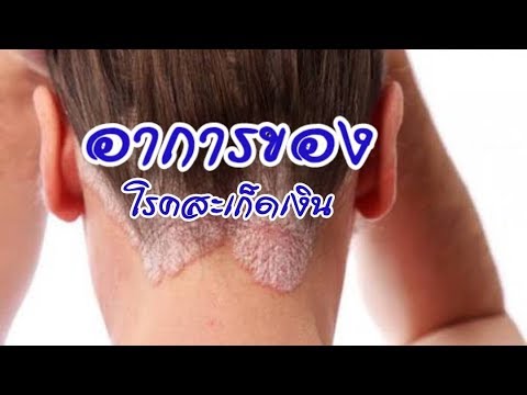 สาเหตุของกลากหน้าแข้ง อาการโรคสะเก็ดเงินกลาก