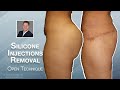 Silicone Injections Removal OPEN TECHNIQUE Plus Breast Augmentation