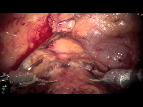 Robotic Prostatectomy with Pre-existing Surgery (Inflatable Reservoir)