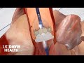 Transcatheter Aortic Valve Replacement TAVR A Less Invasive Alternative To Open Heart Surgery
