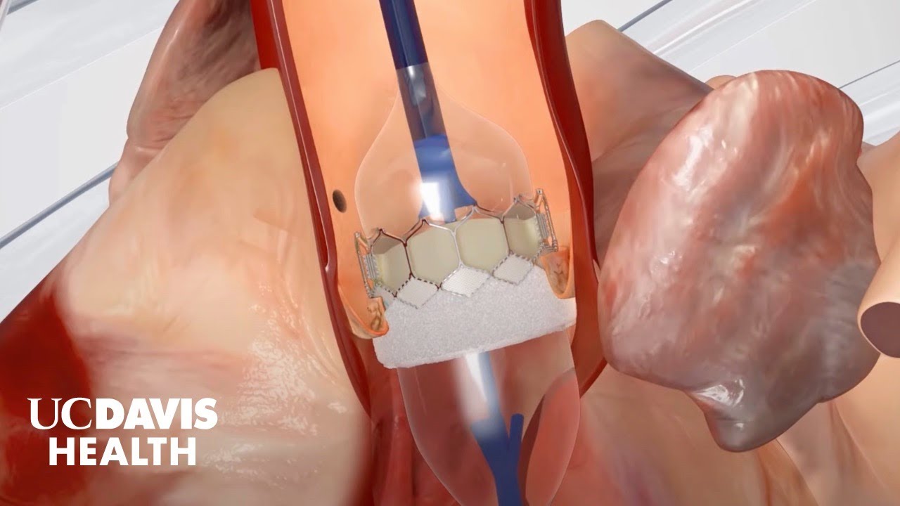 Transcatheter Aortic Valve Replacement (TAVR) - A Less-Invasive Alternative to Open Heart Surgery