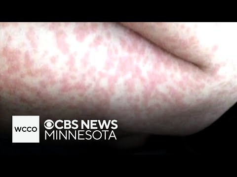 Minnesota's measles cases have doubled in the past week