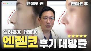 엔젤코 경과 대방출✨성형외과 원장님이 직접 리뷰하는 엔젤코 찐 수술 후기 모음!