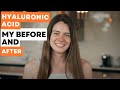 InstaSkincare Hyaluronic Acid Before And After