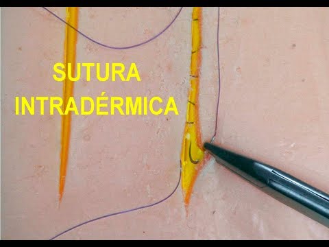 Surgical sutures. Intradermal suture. Required: steady hand, patience, concentration, and practice.