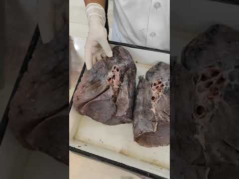 Lung important impressions