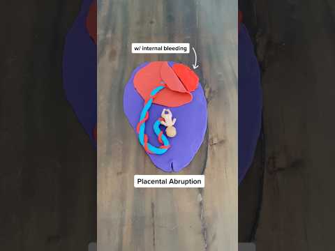 Placenta complications explained! #pregnancy #pregnancytips