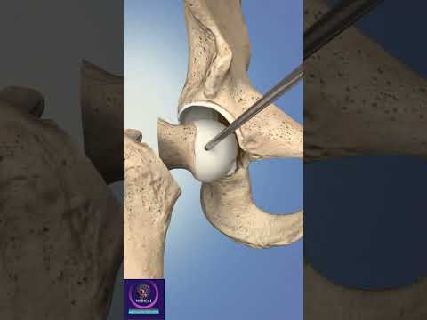 Hip Replacement Anterior Surgery #shorts #education